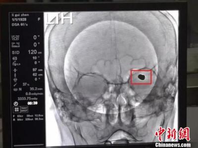 九旬老人腦部長“巨型”動脈瘤 醫(yī)生拆除“不定時炸彈”