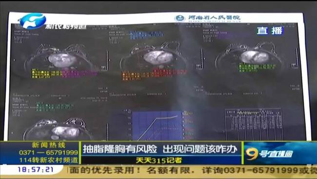 鄭州曹樂醫(yī)療整形：抽脂隆胸不靠譜 整出問題溝通難