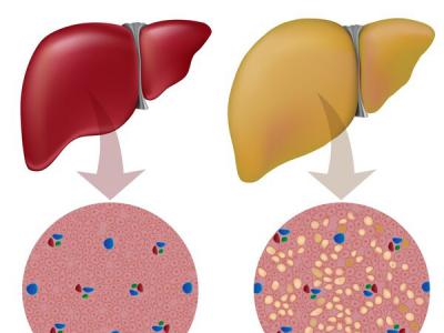 體檢查出輕度脂肪肝不用在意？51年隊(duì)列研究：輕度脂肪肝增加7成死亡風(fēng)險(xiǎn)！