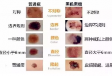 身上的痣千萬不要亂摳！痣的5個惡變信號，你有嗎？