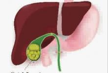 如何護理膽結(jié)石？高危人群要注意