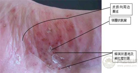 腳氣也是一種病，做到這一點(diǎn)能夠有效預(yù)防腳氣