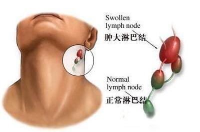 淋巴結(jié)排毒的方法以及定期排毒的好處