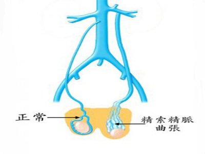 淺靜脈擴張的臨床表現(xiàn)和診斷方法