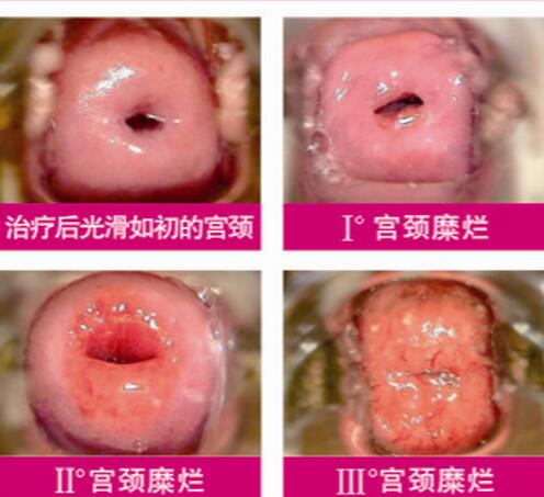 宮頸糜爛一二三度圖片，真實(shí)對比照片(小心是宮頸癌前兆)