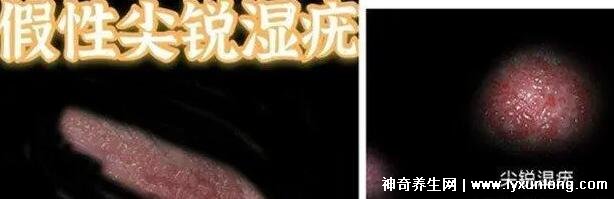 女性假疣和真疣的圖片對比，前者淡紅色和淡褐色魚子狀(5大區(qū)別)