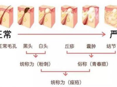 臉上長痘痘怎么調(diào)理？做好這三點(diǎn)讓痘痘遠(yuǎn)離你