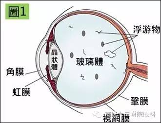 警惕，近視眼更容易得飛蚊癥