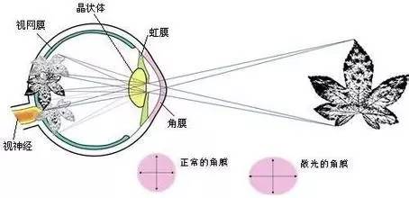 關(guān)于散光，這些你都了解嗎？