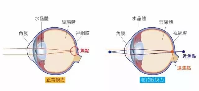 都是視力下降！白內(nèi)障、老花眼有何不同？