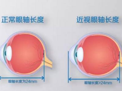 近視不可怕，度數(shù)越來越深才可怕