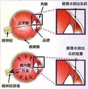 青光眼高發(fā)人群有哪些？