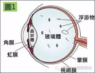 警惕，近視眼更容易得飛蚊癥