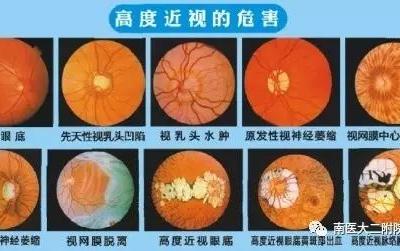 高度近視患者注意六大事項(xiàng)